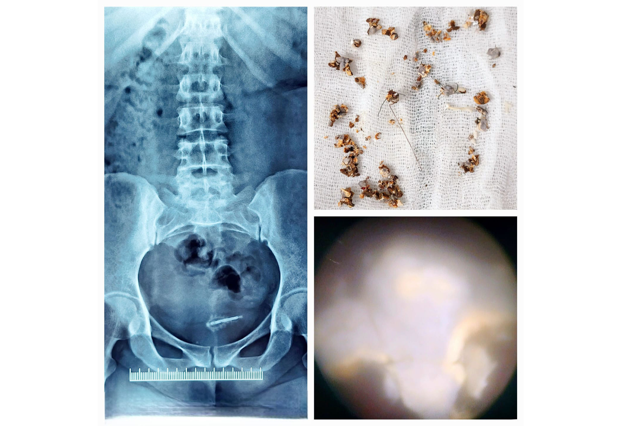 A Rare Case of Copper-T Encrustation in the Bladder